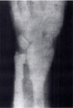 US first X ray